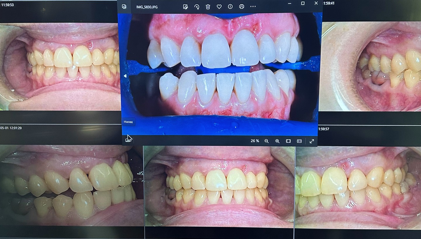 отбеливание zoom фото результата